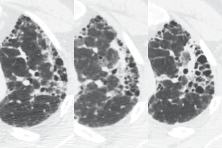 FIGURE 5 Evaluation of complications. Lung cancer in the setting of idiopathic pulmonary fibrosis.