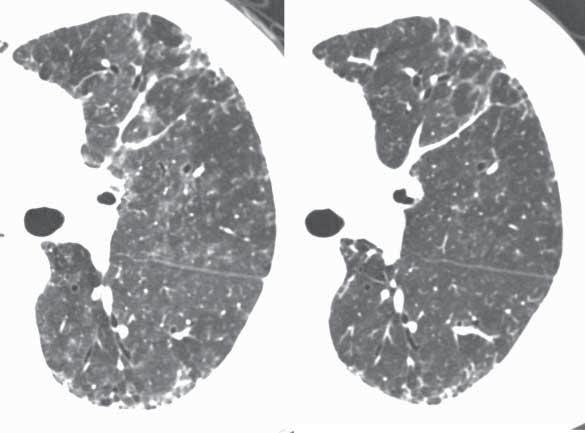 a) b) c) d) FIGURE 1 a-d) Typical changes over time in different diffuse lung diseases.