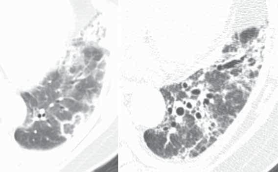 Perilymphatic nodules on the initial HRCT evolve into fibrosis as evidenced by reticulation, architectural distortion, and mild bronchiectasis.