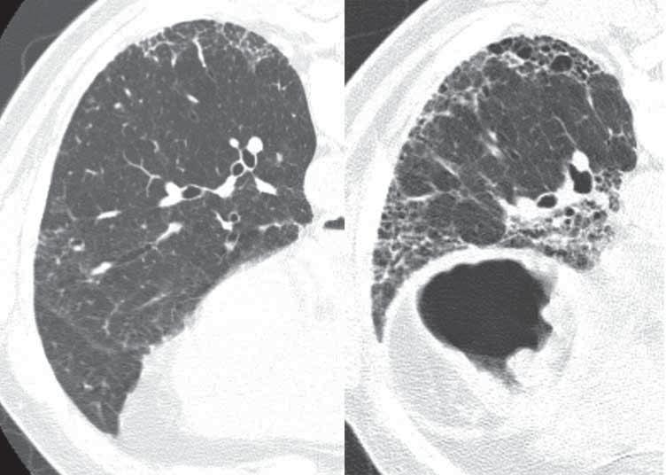 clinical perspective, organising pneumonia is a highly steroid-responsive disease, with clinical improvement in many patients days to weeks after corticosteroid treatment [38].