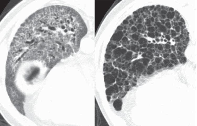 The most typical HRCT findings are patchy bilateral peribronchvascular and subpleural consolidation [40]. Following treatment, most patients show rapid decrease in the size of lung opacities.