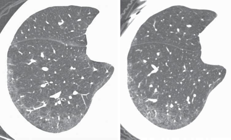 1 year later, a repeat HRCT (right) shows worsening of the lung disease; however, this was not accompanied by a significant change in pulmonary function tests. b) NSIP, microscopic fibrosis.