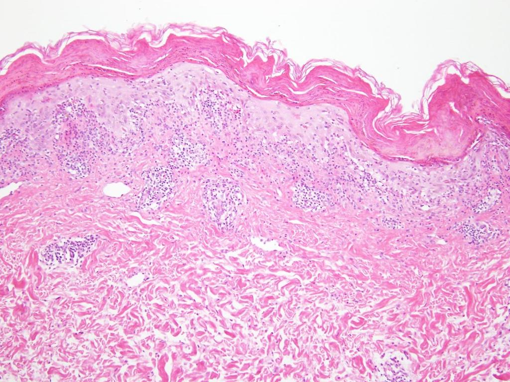 Confluent parakeratosis with