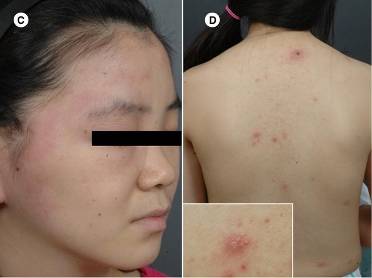 Facial swelling Erythematous papules and vesicles on
