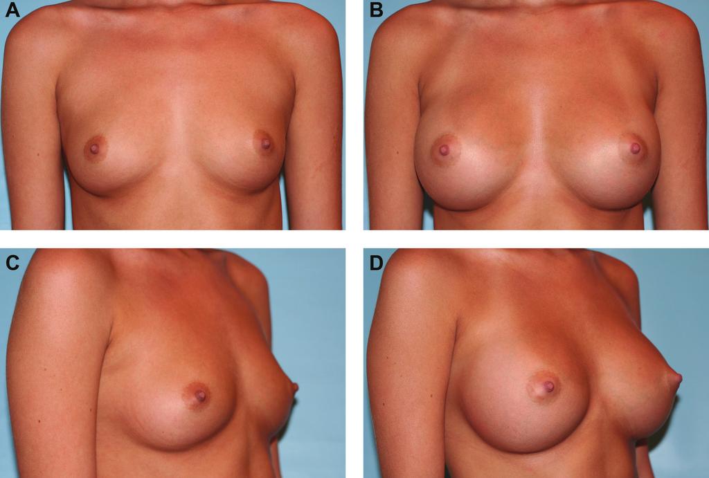Nichter and Hamas 865 Figure 4. (A, C) This nulliparous 19-year-old woman presented for breast enlargement.