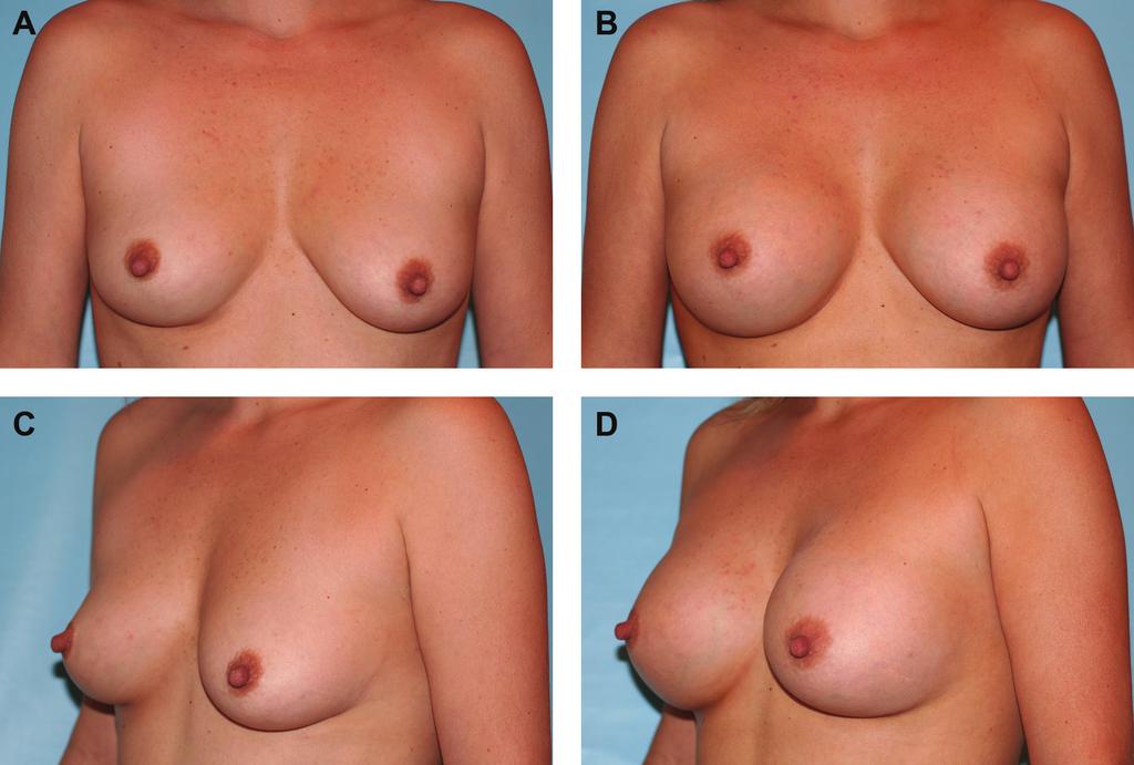 866 Aesthetic Surgery Journal 32(7) Figure 5. (A, C) This 31-year-old woman presented for restoration of breast volume following delivery and nursing of 2 children.
