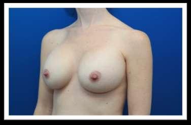 placement: subpectoral (under the muscle) Incision site: