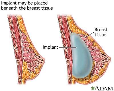 Implant Placement Implants can be placed above or below the muscle. The techniques are described below.