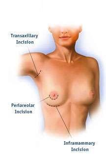 Incision Site There are different options for inserting breast implants. They are described below in detail.