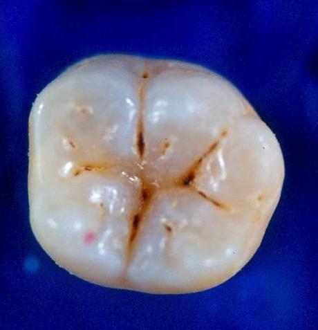 4. Fossa : is a small depression or concavity on the occlusal surface of posterior teeth and the lingual surface of anterior teeth.