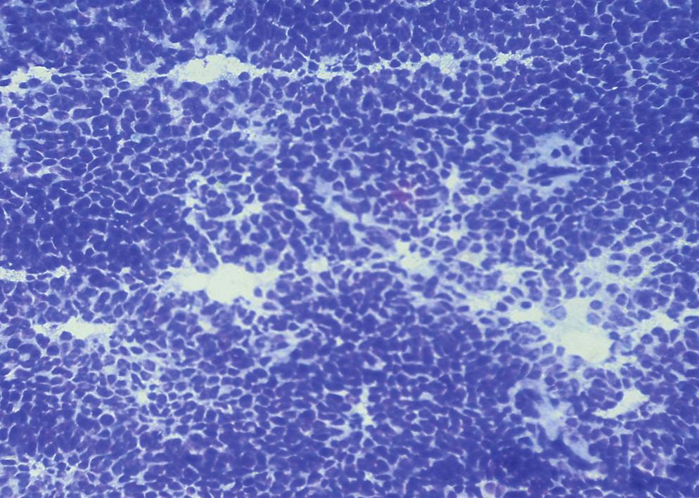 Smears from crush cytology and frozen sections showed predominantly uniform round tumour cells with central prominent nuclei and clumped chromatin. Occasional mitotic figures were noted.