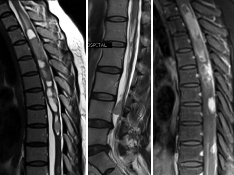 Sagittal T1W MR image of thoracic spine and lumbosacral spine revealed multiple lesions of solid nature with cystic areas of varying sizes dispersed throughout the spinal cord, in the intramedullary