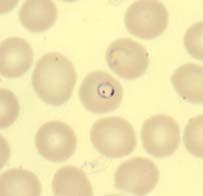 12B C Correct identification: Plasmodium falciparum.