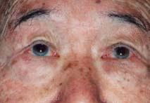 If this occurs in patients under age 50, workups for hypercholesterolemia and hyperlipidemia should be performed. Provided by Dr. Alexander K.C. Leung and Dr. Alexander G. Leong, Calgary, Alberta.