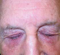 CASE 11 A 52-year-old man presents with a chronic history of pruritic and occasional edematous eyelids. 1. What is your diagnosis? 2.