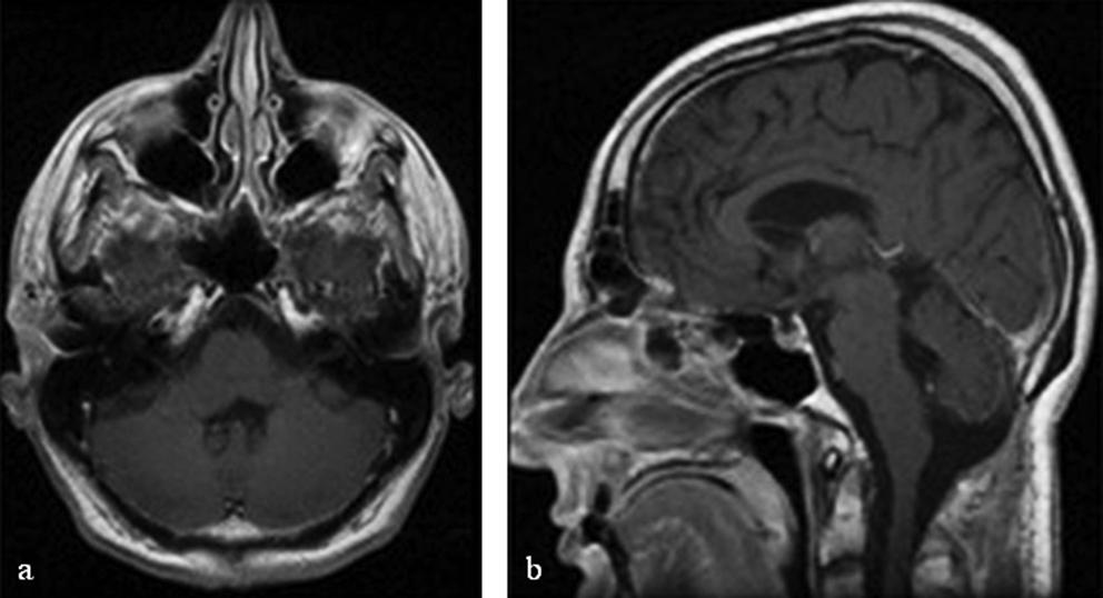 G. Luetjens et al. Fig. 3. Axial (a) and sagittal (b) MR images enhanced with Gd DTPA obtained at the 2-year follow-up show no residual tumor and no detectable recurrence.