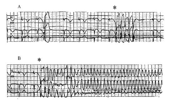 VF storm in pts with ischemic CM N.F.Marrouche et al.