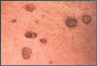 Acrochordon (skin tag) Frequently found in areas of rubbing Characterized by multiple round,