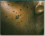 Dermatosis Papulosa Nigra Keloid vs Hypertrophic scar Caused by