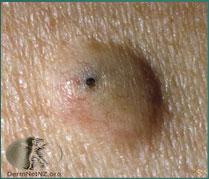 Epidermal Inclusion Cyst The common epidermal or sebaceous cyst occurs primarily of the face, back, base of the ears, chest, and back, but can occur on any skin surface.
