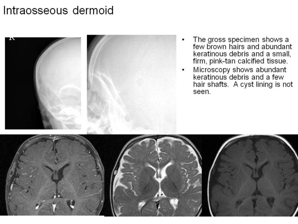 Fig. 10: Intraosseous dermoid Pediatric