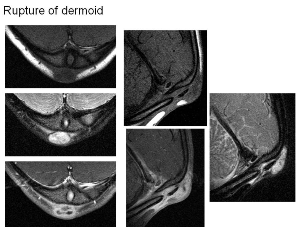 Fig. 15: Ruptured dermoid Pediatric