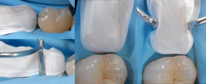 adjacent teeth. Fig. 4 Img.