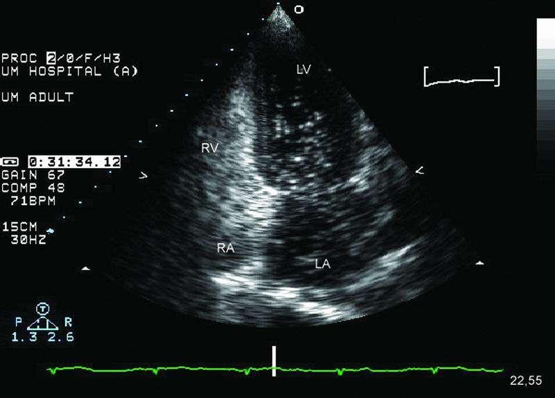 Feigenbaum s Echocardiography, 6 th ed. Ch. 22, 2005. Patient evaluated for cardioembolic disease.