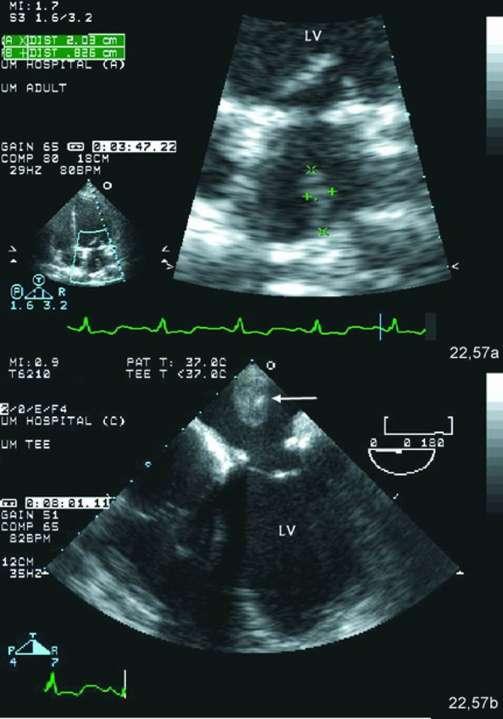 Top: Expanded view of A4C in patient with prior mitral annular ring for MR.
