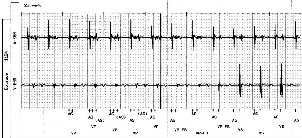 Stored Electrograms moment of AT detection Ventricular far-field oversensing memory