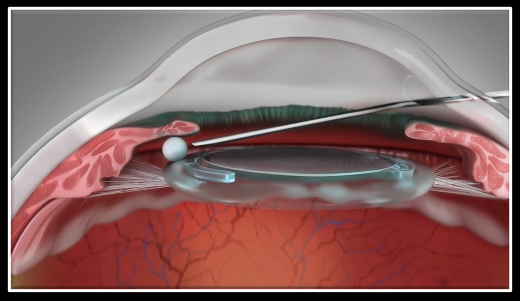 DEXYCU Uses Verisome Technology to Deliver 517 μg of Dexamethasone1 Administered as a single dose of 5-µL, intraocularly into the posterior chamber inferiorly behind the iris at the end of ocular
