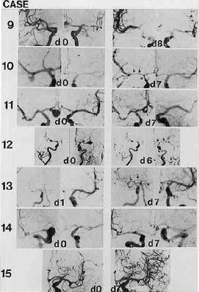 Intracisternal rtpa after subarachnoid hemorrhage FIG, 5. Preoperative and followup cerebral angiograms in the last seven patients treated in the series.
