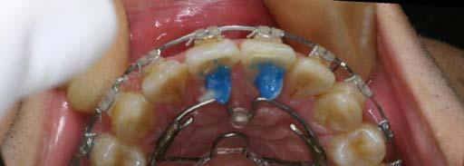 first molar, and the other is to the transpalatal bar. This provides intrusion and distalization of the left molar.