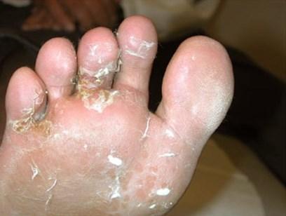 Interdigital (frequently) Pruritic Erythematous erosions or scale Topical