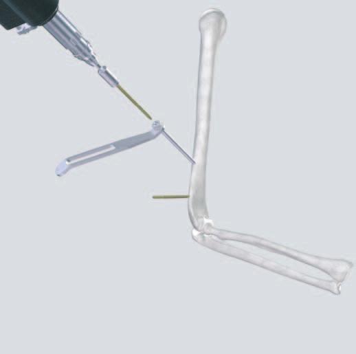 Surgical Technique The following steps are explained with reference to the large external fixator and self-drilling, self-tapping (Seldrill) Schanz screws.