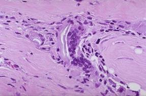 Foreign Body Langhan s 5 6 Granuloma Focal area (often small 0.