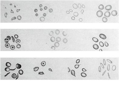 Fundamentals 42 Disturbances of Iron Metabolism Fig. 18: Normal and pathologic forms of erythrocytes sis and cell maturation (Fig. 17). Deficiencies similarly lead to macrocytic anemia.