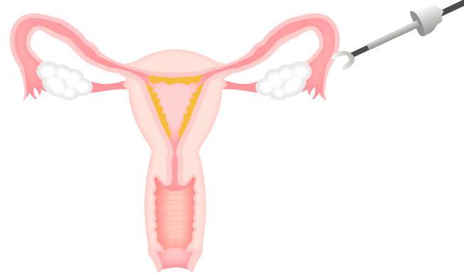 Fertility surgery Laparoscopy Tubal