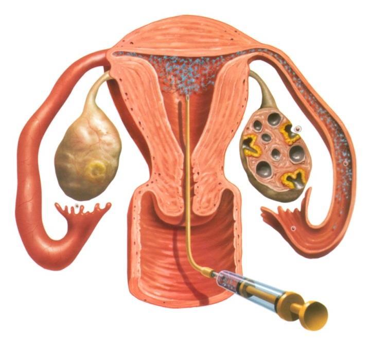 Intrauterine Insemination Ovulation monitoring plus the insertion of washed sperm