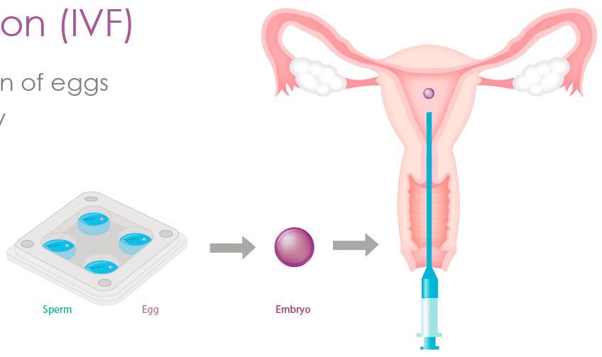 IVF Sperm fertilises the eggs in the laboratory (rather than fallopian tube) The fertilised