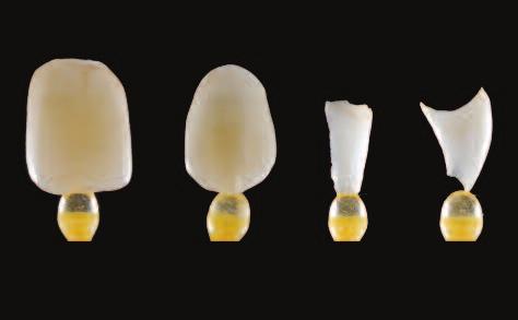 One of the gaps in restorative dentistry today is how to achieve resistance and long-term stability in large bridges with zirconia.