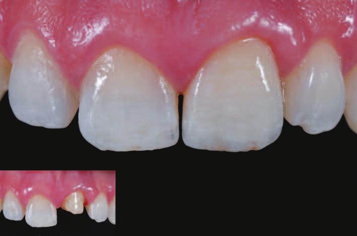 In many countries, it is still much cheaper to do nonprecious restorations than to do zirconia.