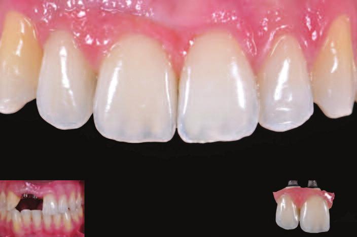 Coachman Figure 7: The pink hybrid restoration is a good alternative for very challenging ridge defect cases inside the esthetic zone.