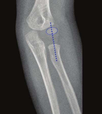 after closed reduction. Arrow head shows laterally dislocated radial head.