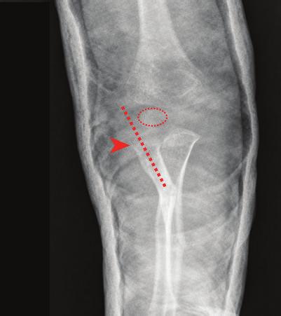 In case of a Monteggia fracture-dislocation, both bone forearm fractures