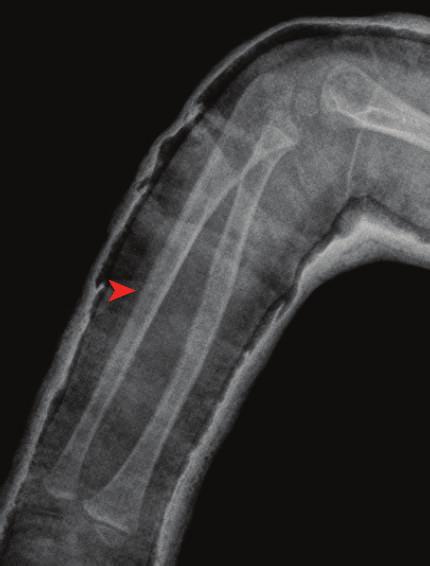 Treatment The ulna was anatomically reduced after closed reduction (Figure 3). An intramedullary Kirschner wire was implanted into the radius.