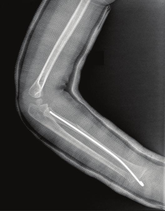 No surgical intervention for stabilization of ulna was planned and a long arm cast was applied. Postoperative radiographs proved the success of reduction (Figure 4).