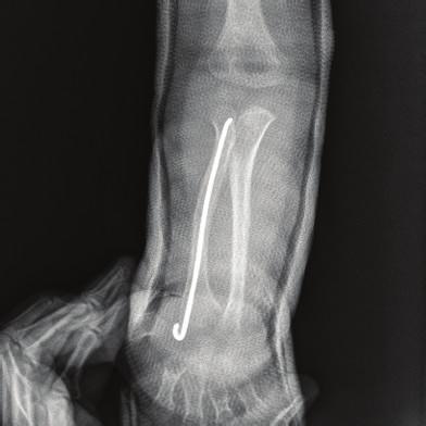 Two weeks after removal of the K-wire, radiographs revealed successful union of both bones (Figure 5).