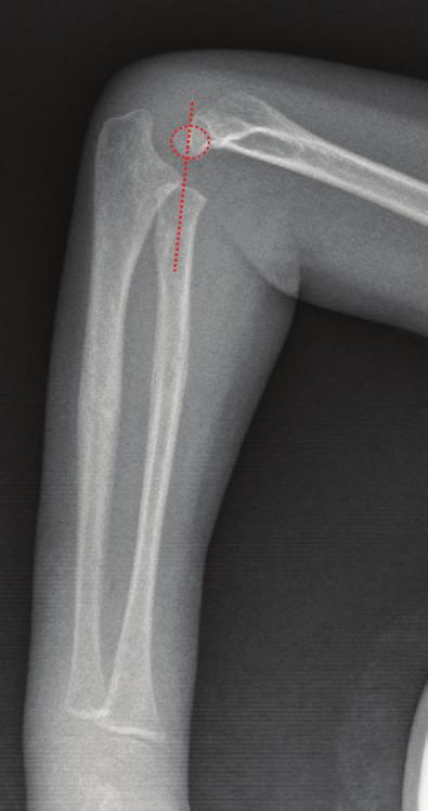 4 Case Reports in Orthopedics Figure 5: Radiographs after K-wire
