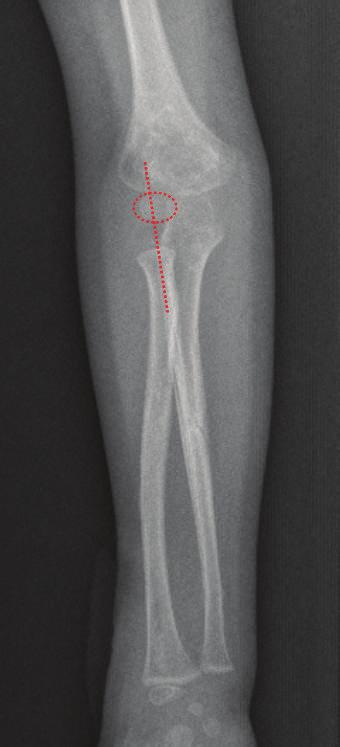 (c) (d) Figure 6: Clinical photos show full ROM of elbow and